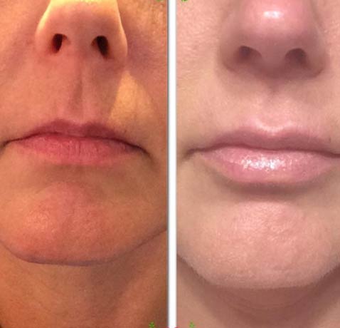 face-fillers-before-and-after