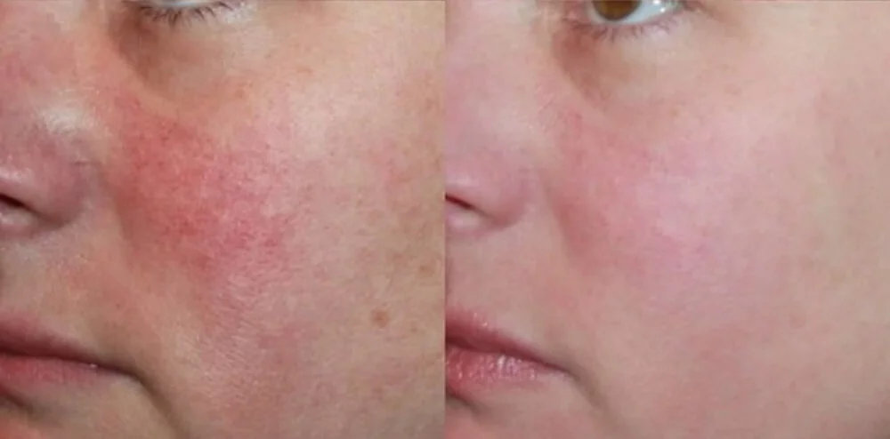 acne-scar-treatment