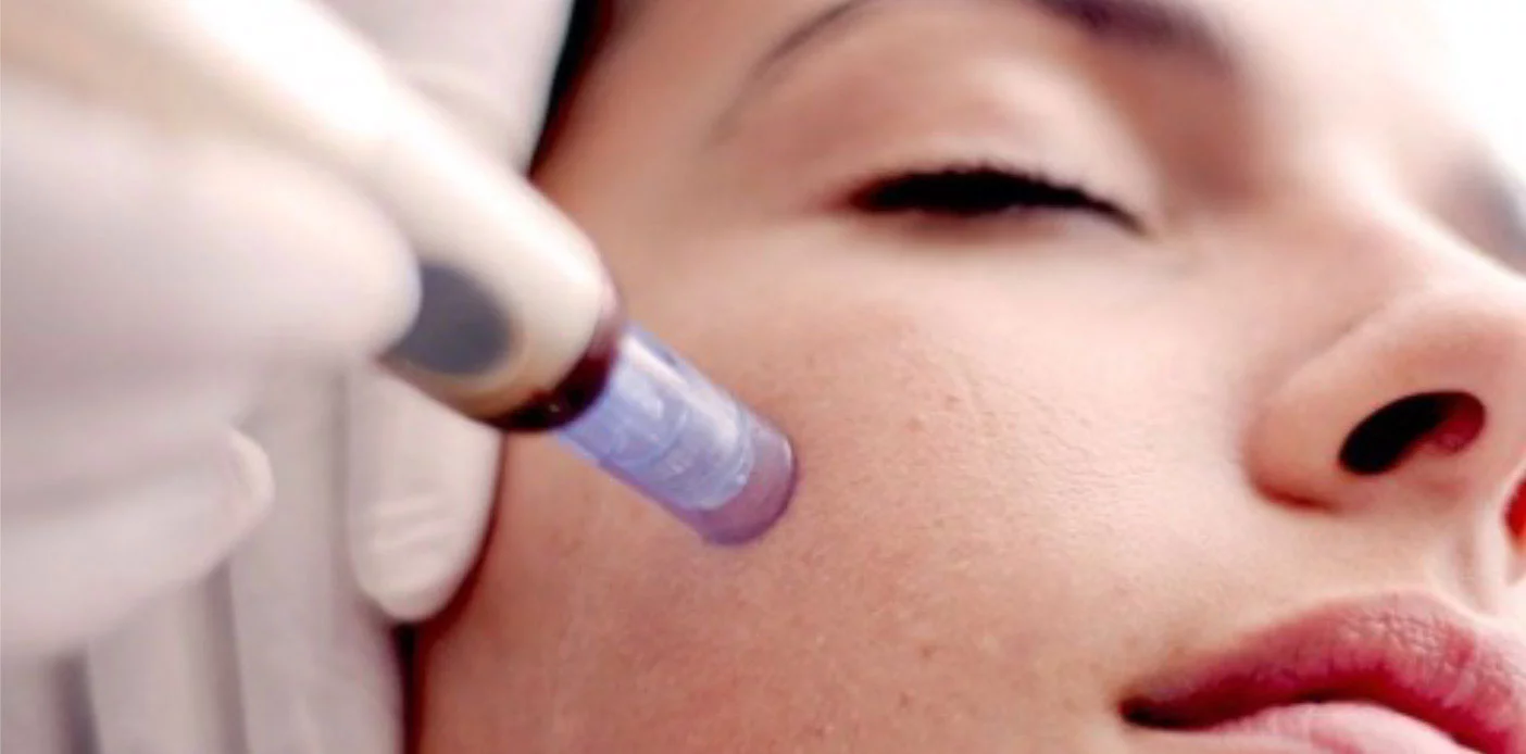 microneedling