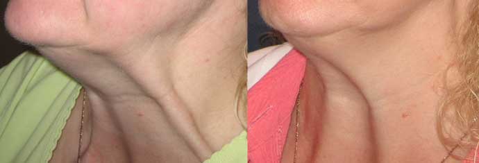 face-fillers-before-and-after