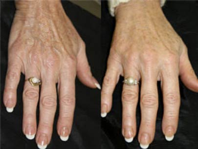 radiesse-filler-before-and-after