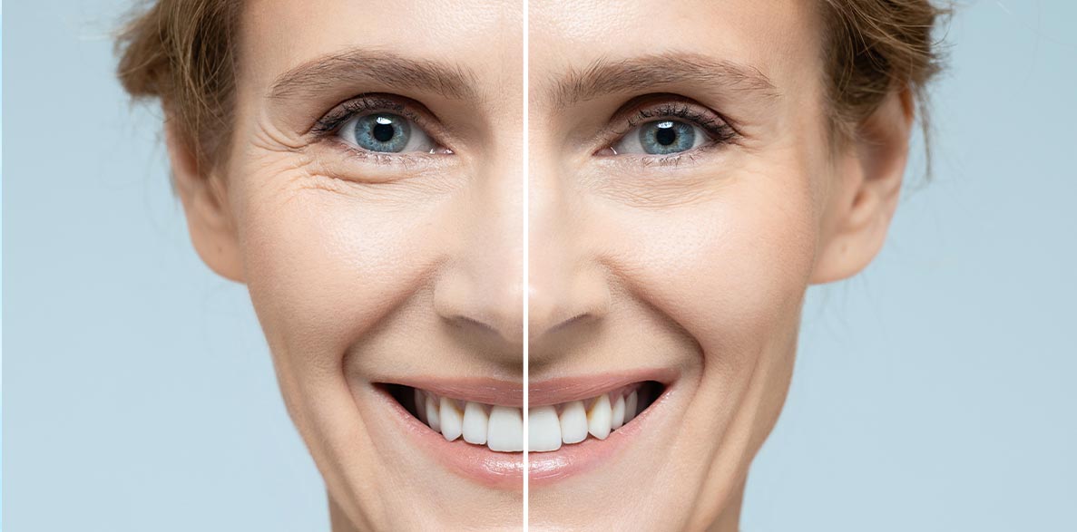 skintightening cryotherapy
